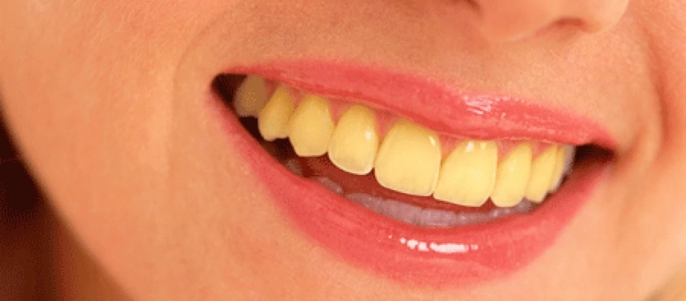 Κίτρινα δόντια: Αντιμετώπιση στο σπίτι με έξυπνες και απλές λύσεις